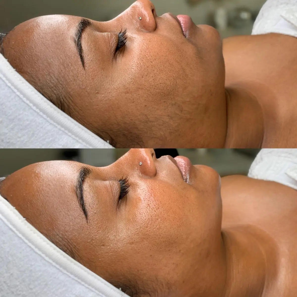 After Skin Rejuvenation