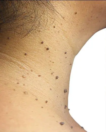 Before Body Treatment Results