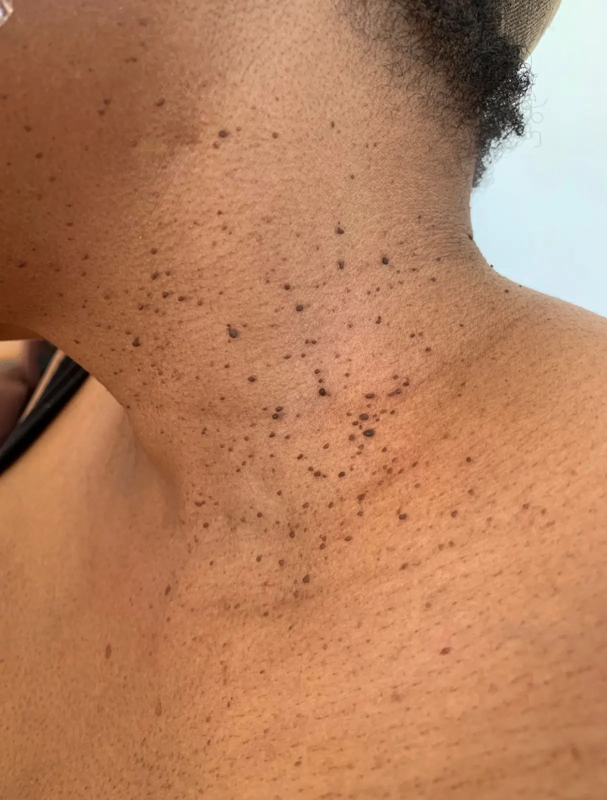 Skin Tag Removal